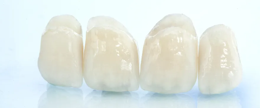 つめ物・かぶせ物