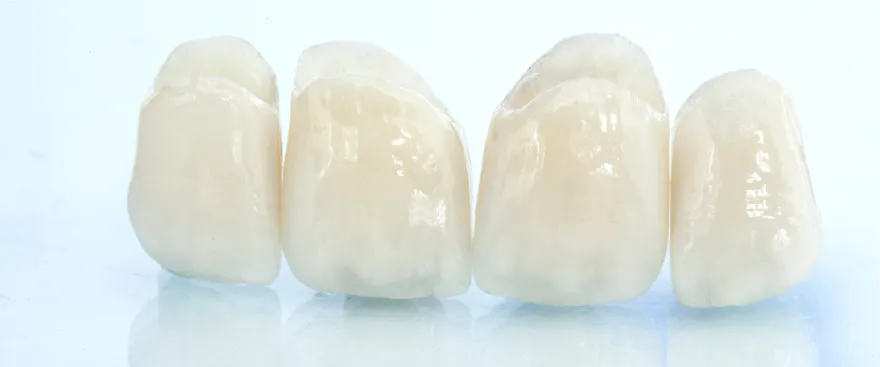 つめ物・被せ物